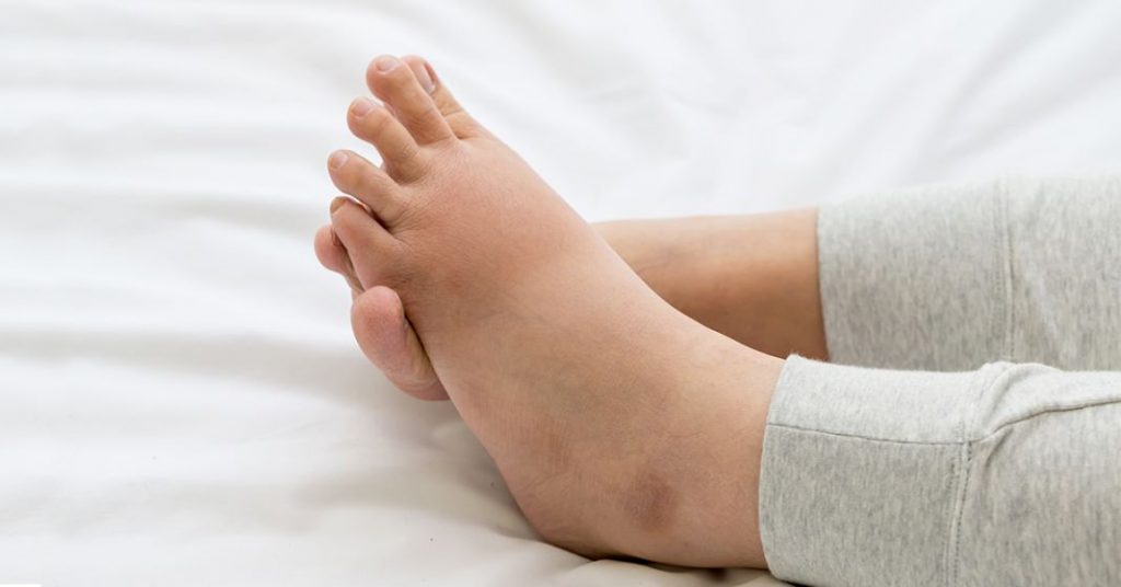 ¿Qué son los pies hinchados?