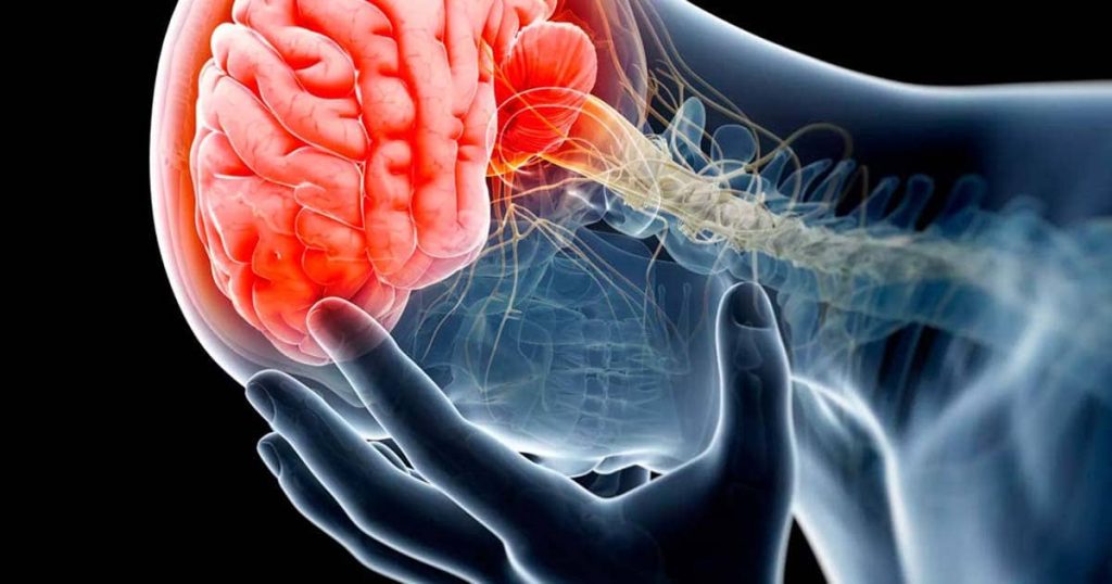 Derrame cerebral síntomas que te avisan antes de que te dé