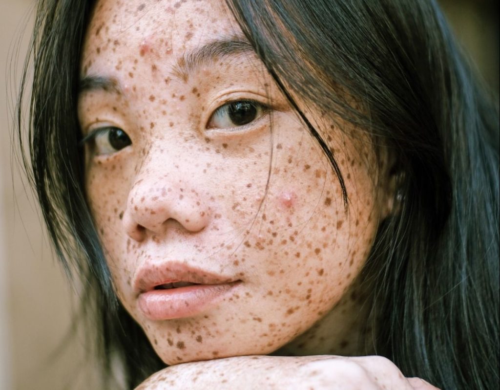 Por qué salen manchas en la cara y cómo evitarlas 1 Vida.es Por qué salen manchas en la cara y cómo evitarlas