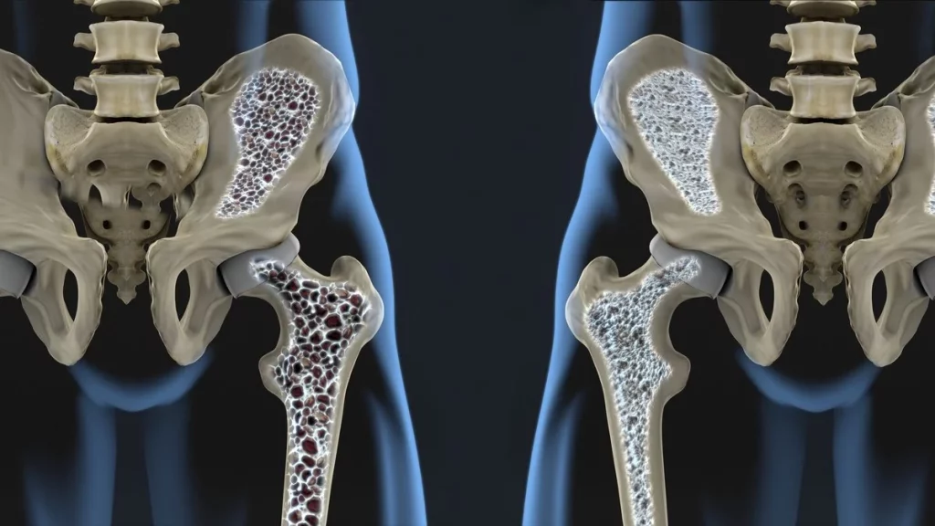 Osteoporosis que es y que sintomas tiene9 Vida.es