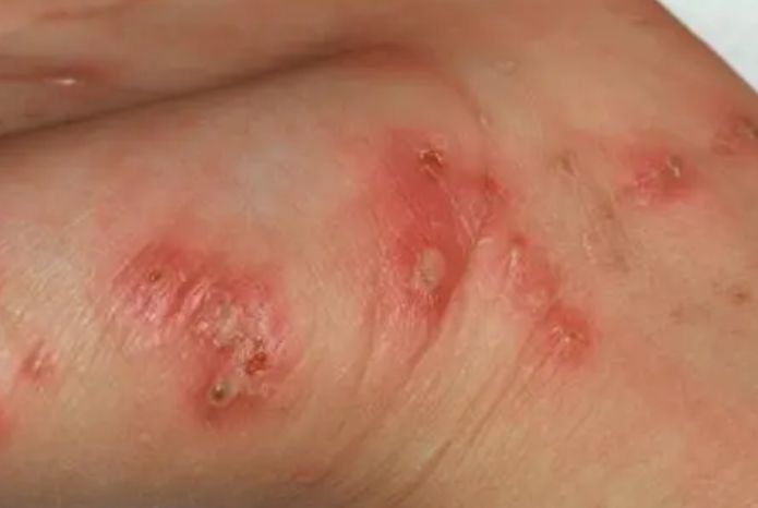 Sarna qué es, síntomas, tratamiento