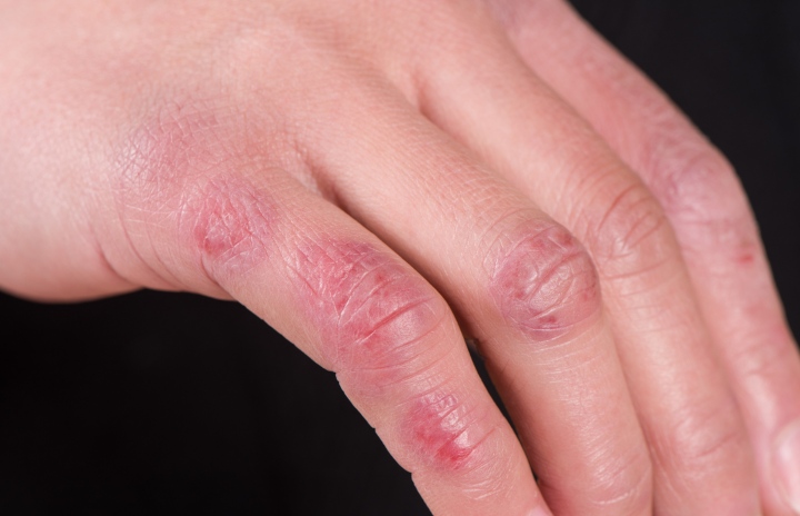 ¿Qué son los sabañones (pernio)?