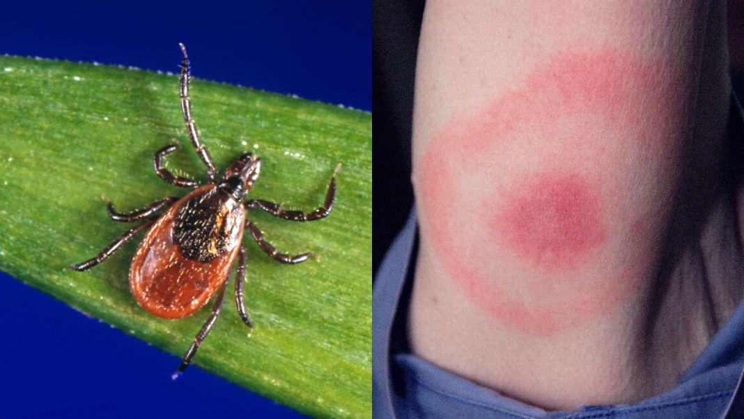 Enfermedad de Lyme: 10 consejos para evitar las mordeduras de garrapatas 2 Vida.es Cómo se diagnostica la enfermedad de Lyme