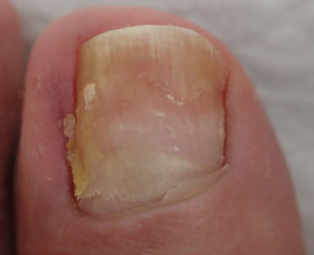 LA IMPORTANCIA DE LA CONSISTENCIA EN EL TRATAMIENTO