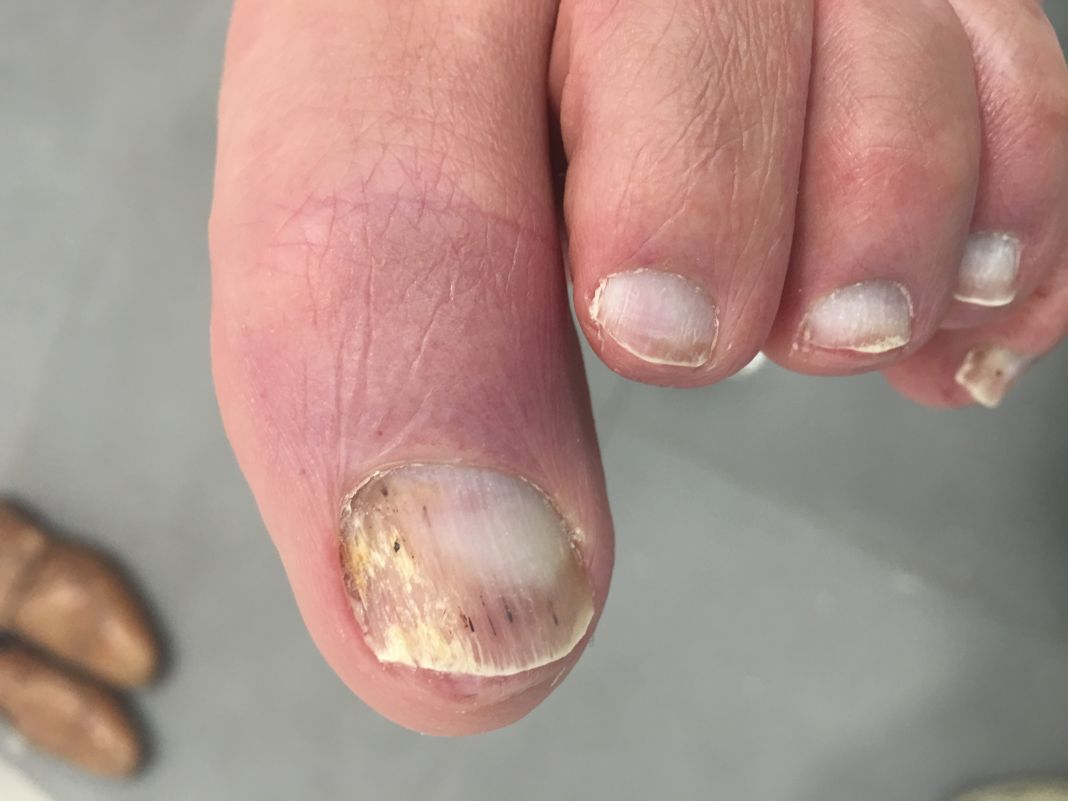 PREVENCIÓN PRIMERO: MANTÉN TUS UÑAS SALUDABLES 