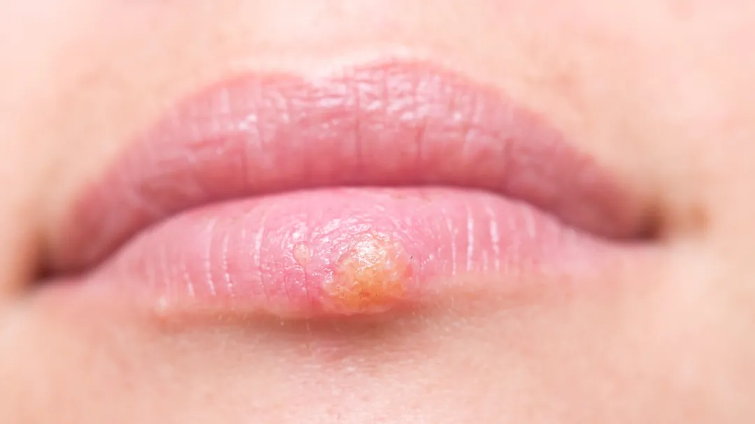 CONOCIENDO AL ENEMIGO: ¿QUÉ ES EL HERPES LABIAL?