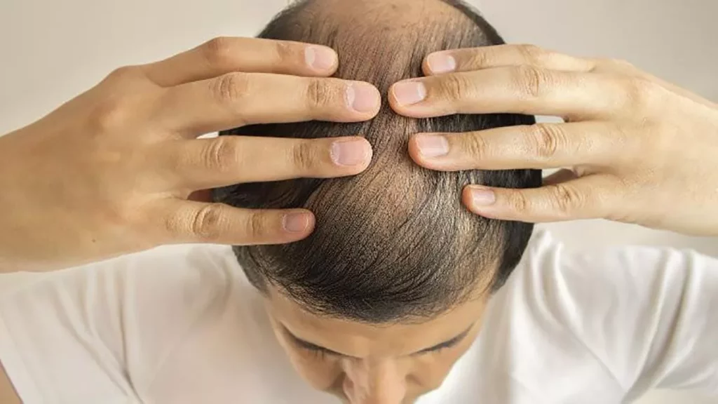 Estrés oxidativo y su relación con la alopecia