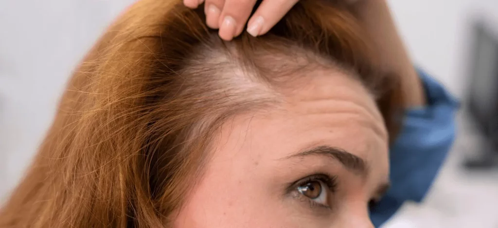 Tipos de grasas y su impacto en la alopecia