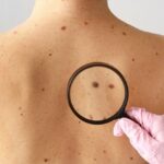 Aprende a identificar las señales del cáncer de piel que a menudo pasan desapercibidas