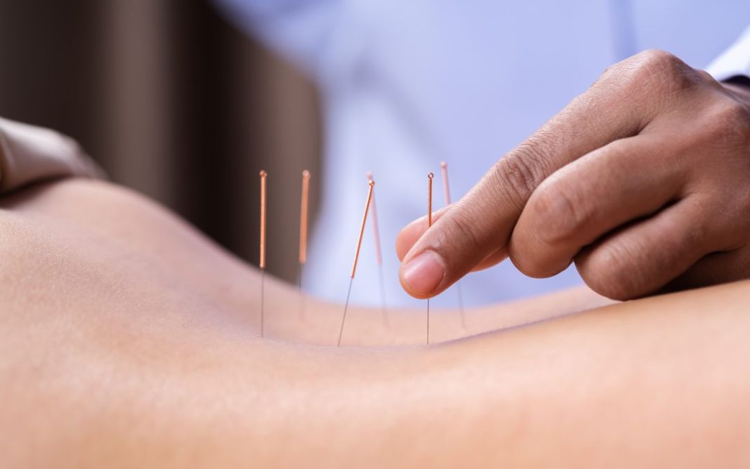 Acupuntura 