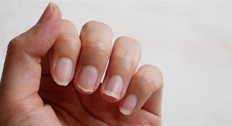 Tipos diferentes de enfermedades en las uñas quebradizas