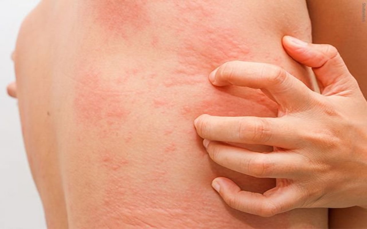 ¿Cuáles son los síntomas de la urticaria?