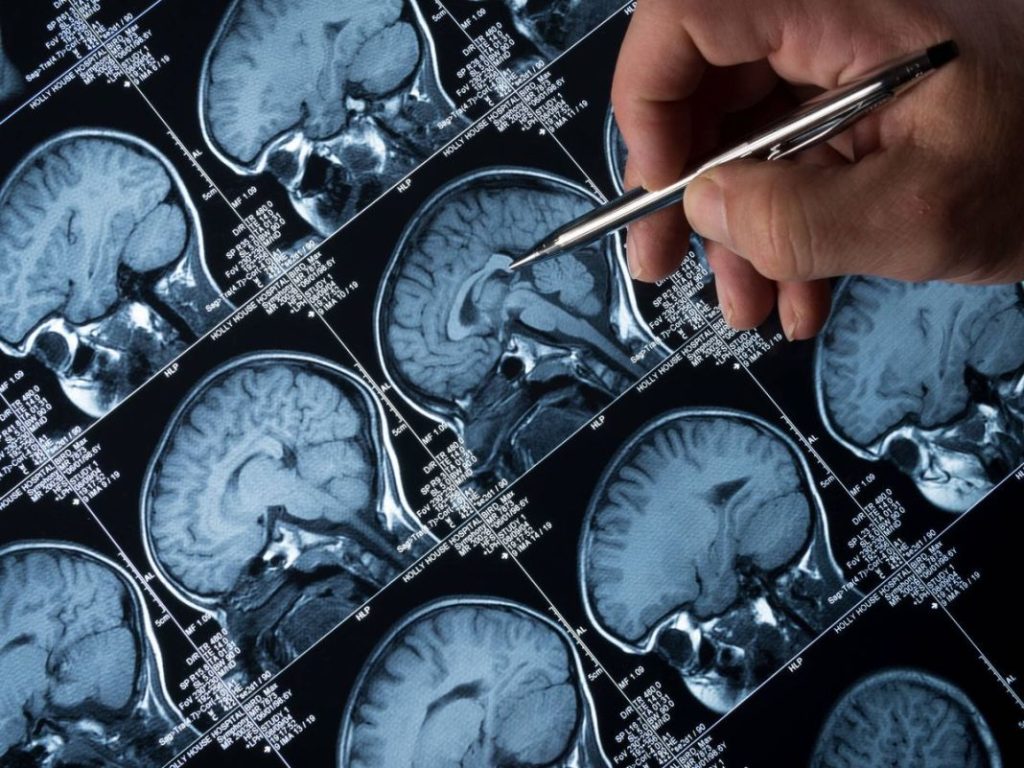 La correlación entre sofocos y riesgo de enfermedad de Alzheimer