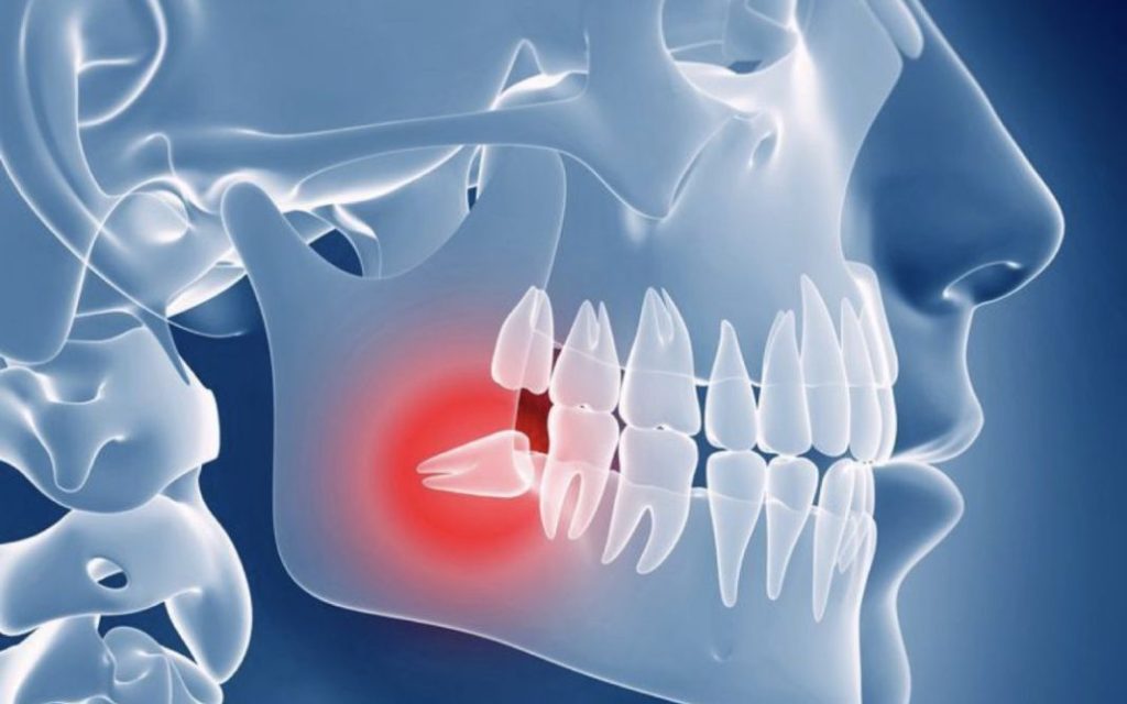 El tamaño reducido de la mandíbula humana y su impacto en las muelas del juicio