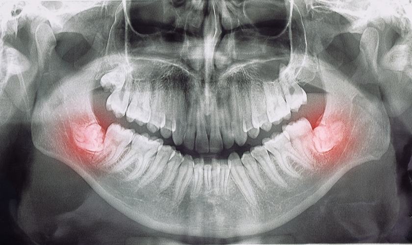 La evolución de la mandíbula humana y la aparición de las muelas del juicio