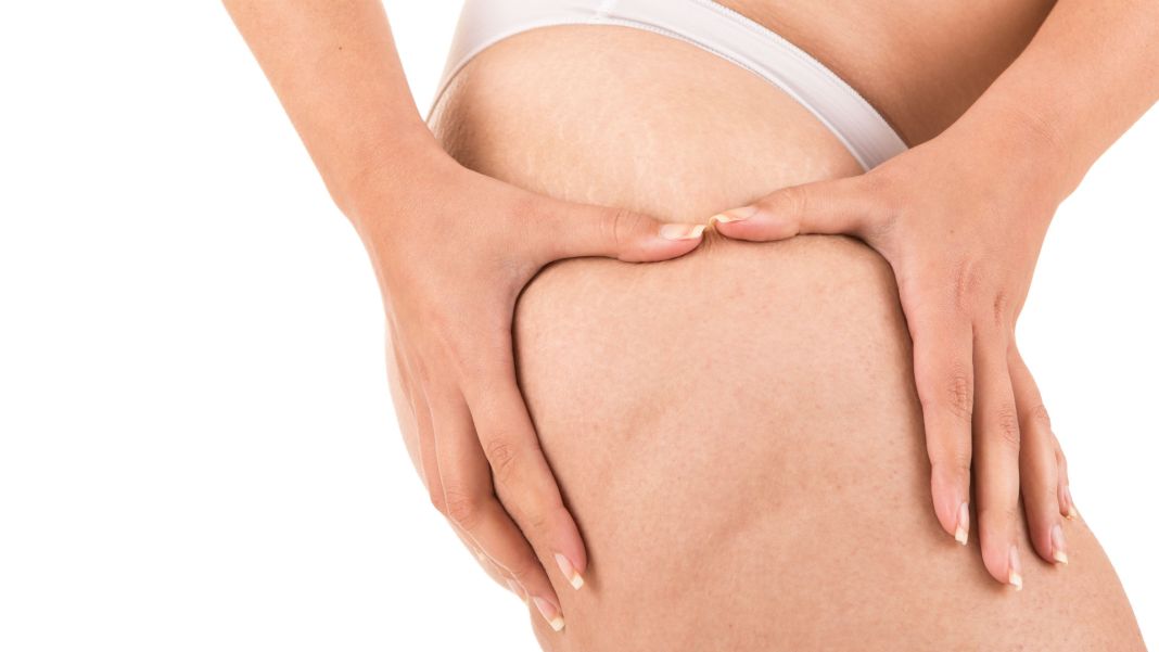 CELULITIS: ALIMENTOS CLAVE