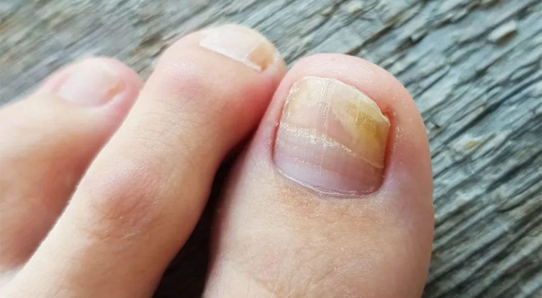 UÑAS AMARILLAS: PREVENCIÓN EFECTIVA