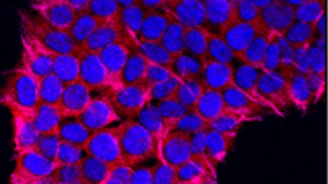 Cáncer de piel: señales que te avisan del peligro de padecerlo 1 Vida.es Cáncer de piel: señales que te avisan del peligro de padecerlo