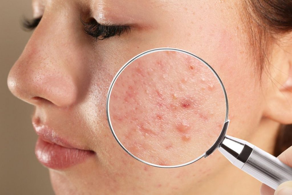 ¿Qué es el acné?