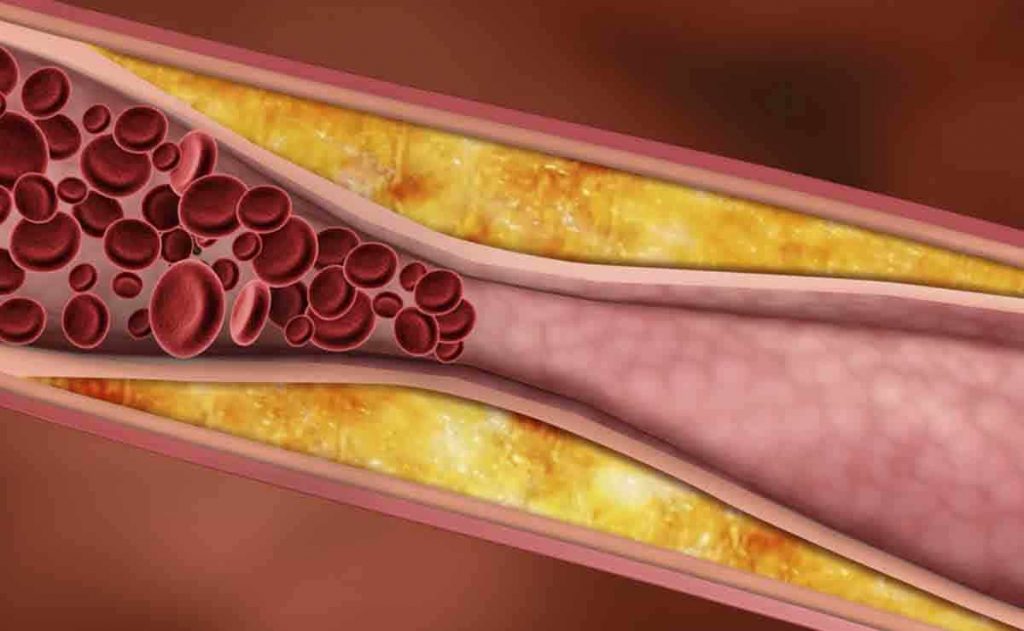 Riesgos y peligros de los triglicéridos altos 1 Vida.es No sólo se trata de la presión