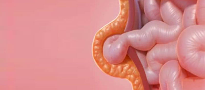 Hernia abdominal: síntomas que te avisan de un problema grave 1 Vida.es Hernia abdominal: síntomas que te avisan de un problema grave