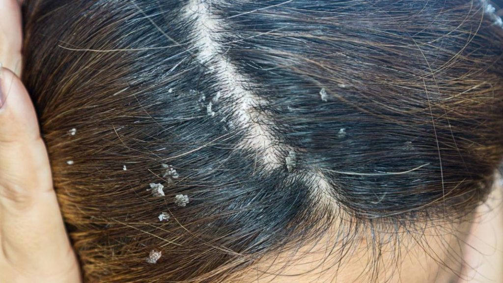 Plantas naturales que combaten la caspa 1 Vida.es Plantas naturales que combaten la caspa