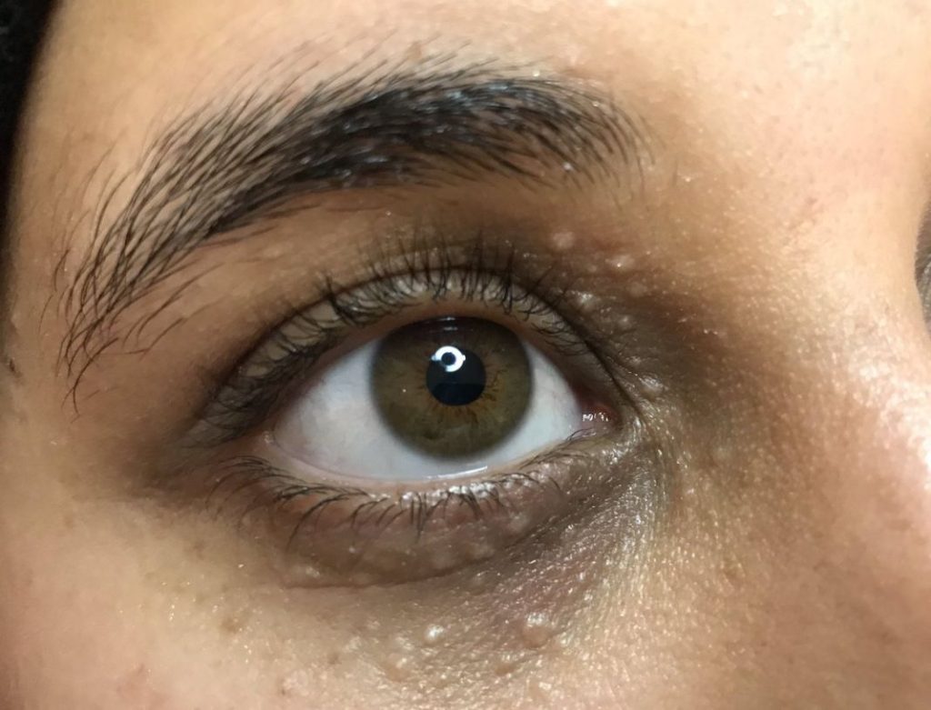 El motivo por el que te salen granos y verrugas cerca de los ojos 1 Vida.es El motivo por el que te salen granos y verrugas cerca de los ojos