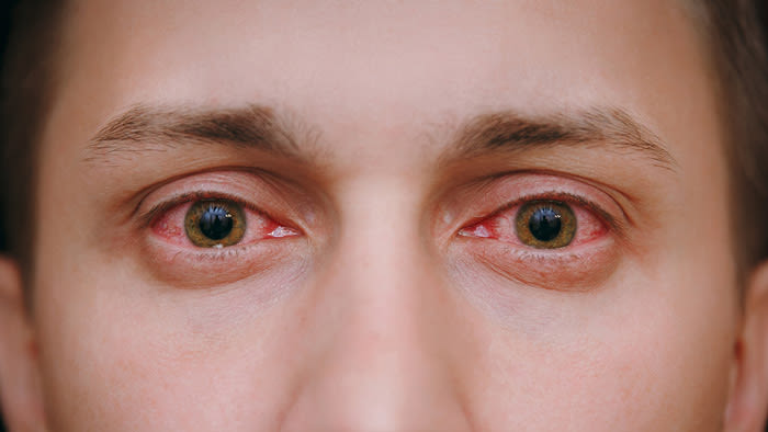 Por qué tenemos los ojos rojos