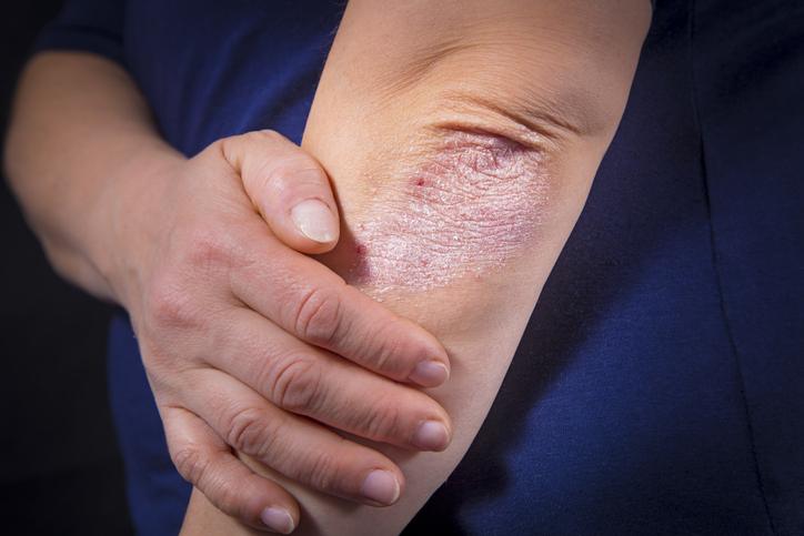 Remedios caseros que ayudan a tratar la psoriasis 1 Vida.es ¿Qué es la psoriasis de todos modos?