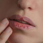 Labios cortados: el remedio casero que funciona rápido