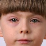 Ojos supurantes en un niño: 5 posibles causas