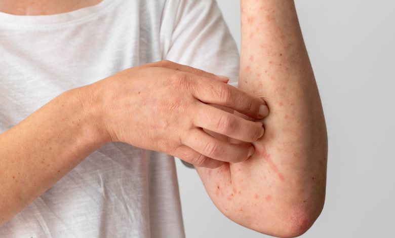 Diferencias entre una dermatitis de una alergia   