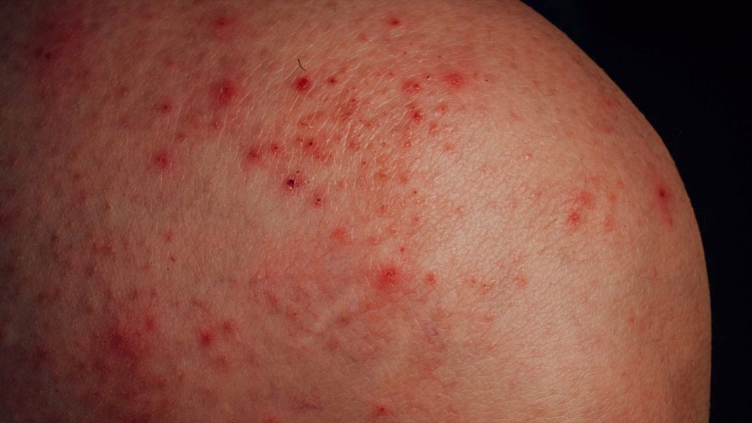 ¿Cómo se manifiesta el eczema?