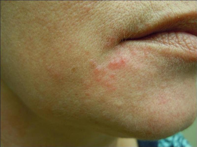 ¿Qué factores pueden contribuir al empeoramiento del eczema?