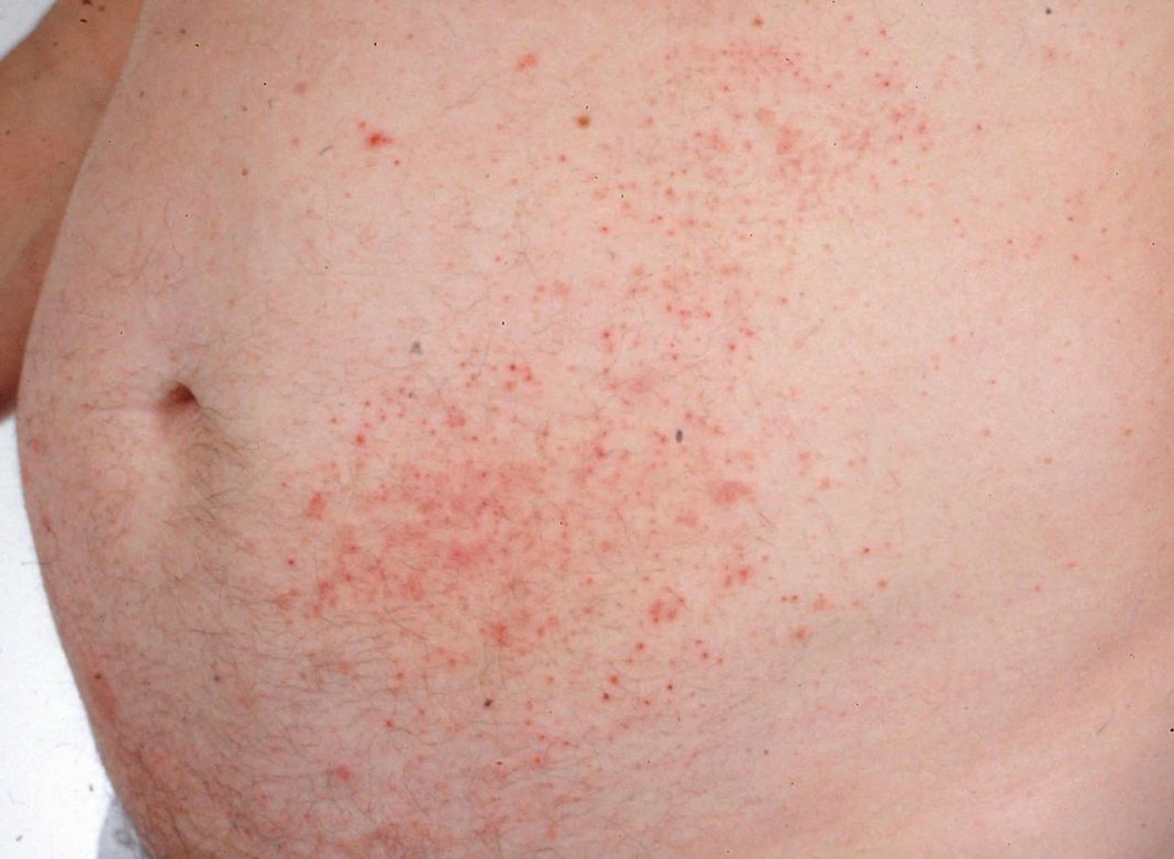 ¿Cómo puede ayudar un médico a tratar el eczema?