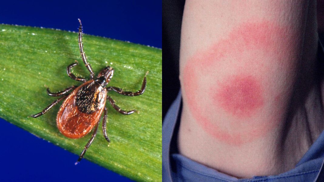 Cómo se diagnostica la enfermedad de Lyme