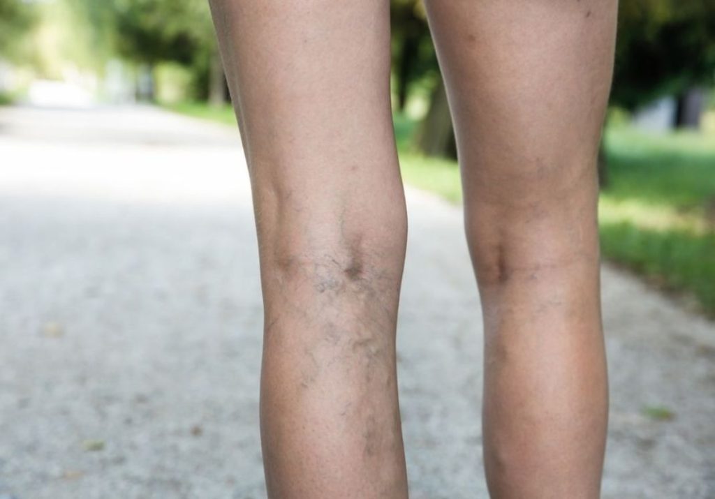 Así puedes reducir el dolor de varices sin ejercicio 1 Vida.es Las venas varicosas duelen por muchas razones diferentes
