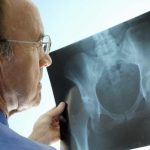 Osteoporosis: 5 claves para fortalecer los huesos