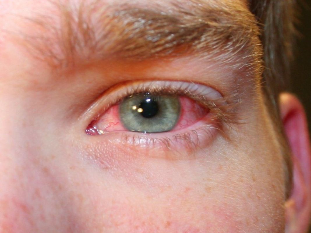 ¿Cómo se puede aliviar el dolor ocular?