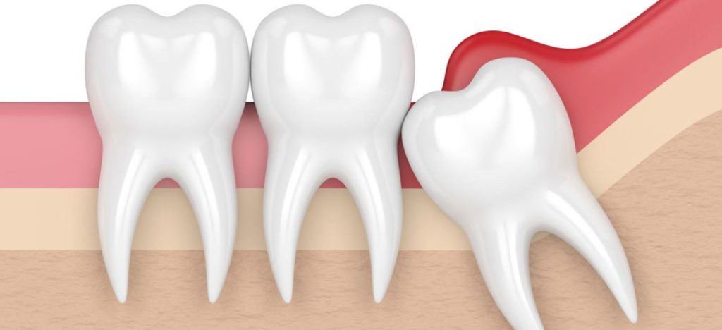 ¿Conoces la razón por la que tenemos muelas del juicio? 3 Vida.es La herencia genética y la aparición de las muelas del juicio