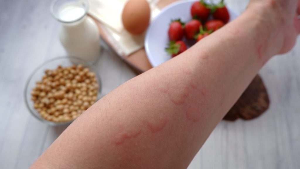 Errores en tu cocina que incrementan el riesgo de intoxicarse 4 Vida.es No prestar atención a las alergias y restricciones dietéticas